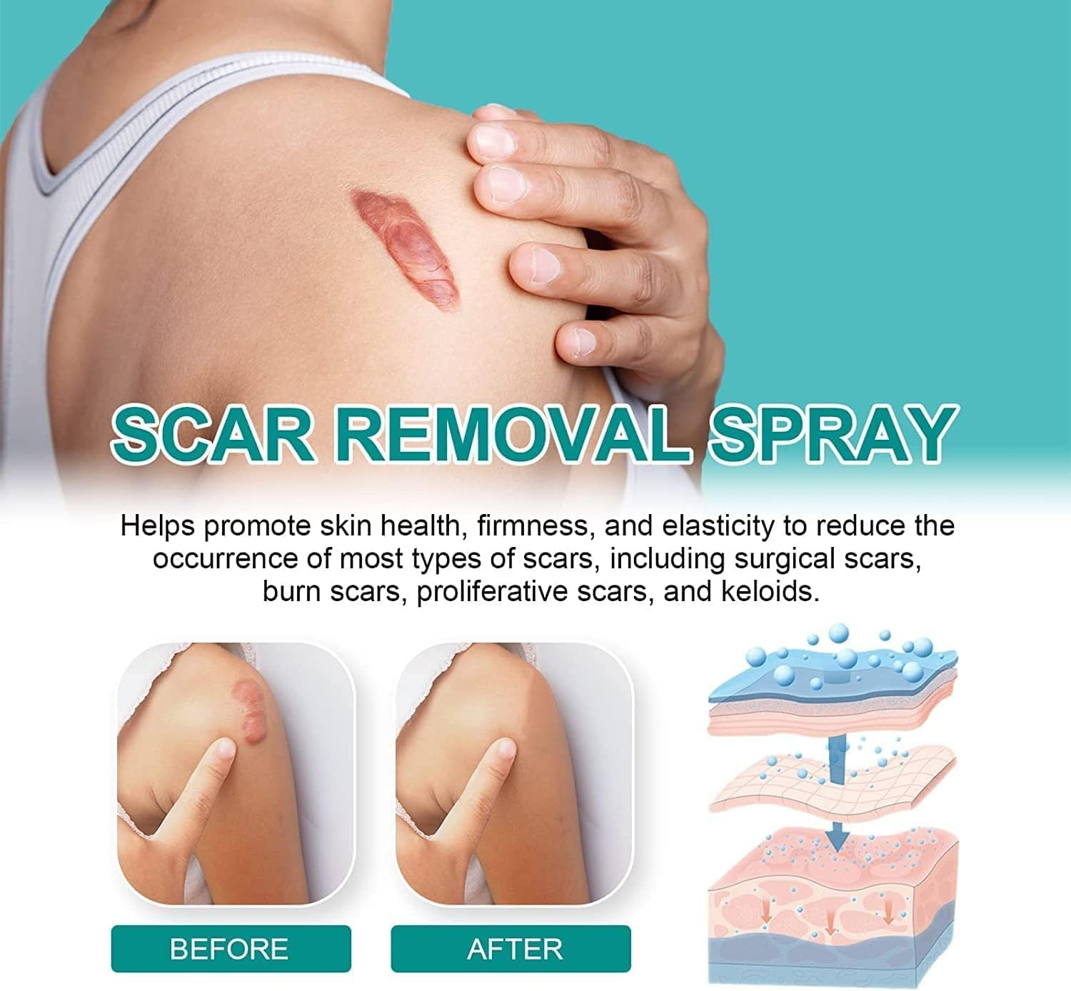 SCAR REMOVAL SPRAY